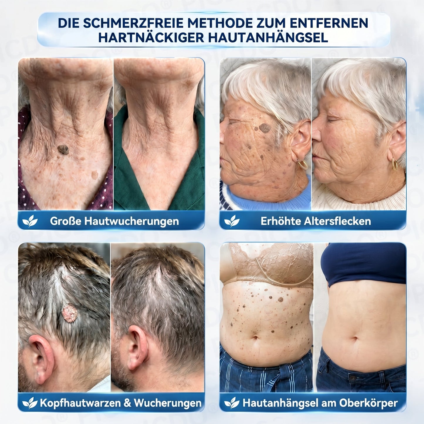 𝐏𝐢𝐜𝐝𝐨® 𝟕-𝐓𝐚𝐠𝐞 𝐇𝐚𝐮𝐭𝐚𝐧𝐡ä𝐧𝐠𝐬𝐞𝐥- & 𝐅𝐥𝐞𝐜𝐤𝐞𝐧-𝐄𝐧𝐭𝐟𝐞𝐫𝐧𝐮𝐧𝐠𝐬𝐜𝐫𝐞𝐦𝐞 (𝐒𝐜𝐡𝐦𝐞𝐫𝐳𝐟𝐫𝐞𝐢𝐞 𝐅𝐨𝐫𝐦𝐞𝐥 – 𝐨𝐡𝐧𝐞 𝐍𝐚𝐫𝐛𝐞𝐧)🌹🌹🌹