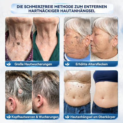 𝐏𝐢𝐜𝐝𝐨® 𝟕-𝐓𝐚𝐠𝐞 𝐇𝐚𝐮𝐭𝐚𝐧𝐡ä𝐧𝐠𝐬𝐞𝐥- & 𝐅𝐥𝐞𝐜𝐤𝐞𝐧-𝐄𝐧𝐭𝐟𝐞𝐫𝐧𝐮𝐧𝐠𝐬𝐜𝐫𝐞𝐦𝐞 (𝐒𝐜𝐡𝐦𝐞𝐫𝐳𝐟𝐫𝐞𝐢𝐞 𝐅𝐨𝐫𝐦𝐞𝐥 – 𝐨𝐡𝐧𝐞 𝐍𝐚𝐫𝐛𝐞𝐧)🌹🌹🌹
