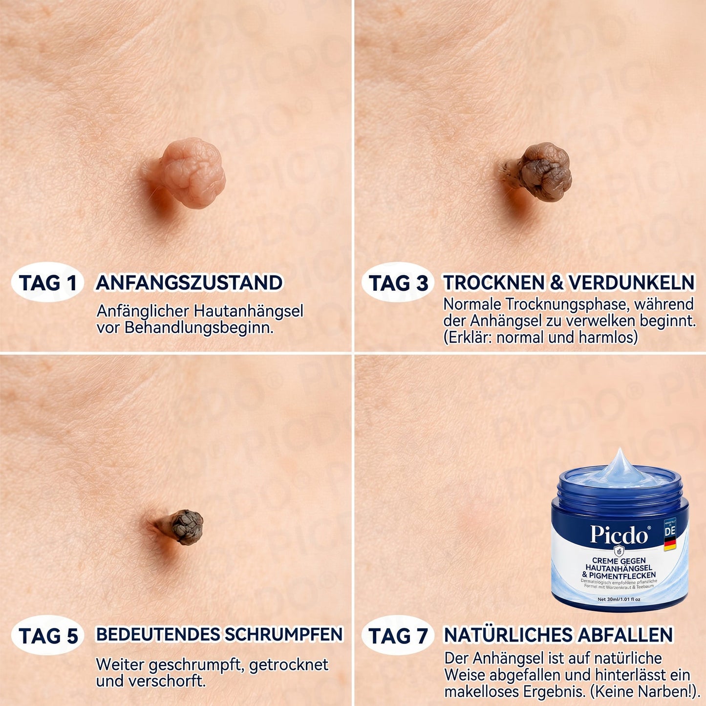 𝐏𝐢𝐜𝐝𝐨® 𝟕-𝐓𝐚𝐠𝐞 𝐇𝐚𝐮𝐭𝐚𝐧𝐡ä𝐧𝐠𝐬𝐞𝐥- & 𝐅𝐥𝐞𝐜𝐤𝐞𝐧-𝐄𝐧𝐭𝐟𝐞𝐫𝐧𝐮𝐧𝐠𝐬𝐜𝐫𝐞𝐦𝐞 (𝐒𝐜𝐡𝐦𝐞𝐫𝐳𝐟𝐫𝐞𝐢𝐞 𝐅𝐨𝐫𝐦𝐞𝐥 – 𝐨𝐡𝐧𝐞 𝐍𝐚𝐫𝐛𝐞𝐧)🌹🌹🌹